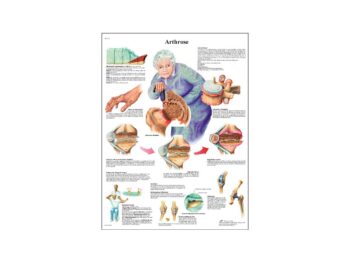 Lehrtafel - Arthrose