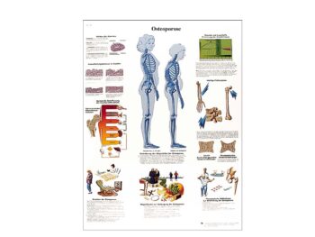 Lehrtafel - Osteoporose